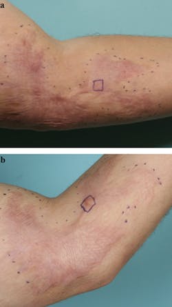 An erythematous hypertrophic burn scar prior to treatment with fractional CO2 laser (a), and a hypertrophic burn scar two months following three fractional CO2 laser treatments. An erythematous hypertrophic burn scar prior to treatment with fractional CO2 laser (a), and a hypertrophic burn scar two months following three fractional CO2 laser treatments.