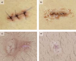 An incision in the skin of the abdomen closed using traditional sutures (a) and laser soldered using human albumin (b) is compared two days after surgery. Thirty days after surgery, the sutured scar (c) is much larger and more noticeable than the laser soldered scar (d). An incision in the skin of the abdomen closed using traditional sutures (a) and laser soldered using human albumin (b) is compared two days after surgery. Thirty days after surgery, the sutured scar (c) is much larger and more noticeable than the laser soldered scar (d).