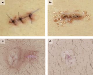 An incision in the skin of the abdomen closed using traditional sutures (a) and laser soldered using human albumin (b) is compared two days after surgery. Thirty days after surgery, the sutured scar (c) is much larger and more noticeable than the laser soldered scar (d).