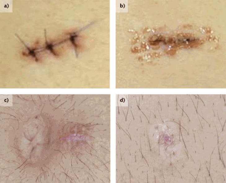 An incision in the skin of the abdomen closed using traditional sutures (a) and laser soldered using human albumin (b) is compared two days after surgery. Thirty days after surgery, the sutured scar (c) is much larger and more noticeable than the laser soldered scar (d).