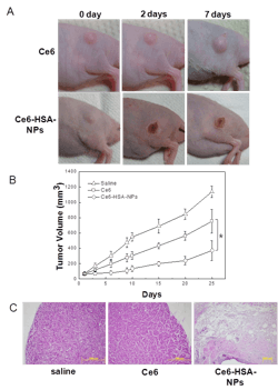 FIGURE 2. Photosensitized (with chlorine e6 or Ce6) human blood proteins (human serum albumin or HSA) can be used to image cancer cells and produce singlet oxygen upon exposure to radiation, visibly killing tumor cells. Images of in vivo photodynamic therapy (a) are shown after intravenous injection of both the control photosensitizer Ce6 and Ce6-HSA nanoparticles with 30 min irradiation of the tumor site with a 671 nm, 6 J/cm2 laser. Tumor growth data (b) is measured for 25 days. After 10 days of treatment, stained tumor tissue (c) confirms the tumor treated with Ce6-HAS nanoparticles is destroyed. Original magnification is 100X. FIGURE 2. Photosensitized (with chlorine e6 or Ce6) human blood proteins (human serum albumin or HSA) can be used to image cancer cells and produce singlet oxygen upon exposure to radiation, visibly killing tumor cells. Images of in vivo photodynamic therapy (a) are shown after intravenous injection of both the control photosensitizer Ce6 and Ce6-HSA nanoparticles with 30 min irradiation of the tumor site with a 671 nm, 6 J/cm2 laser. Tumor growth data (b) is measured for 25 days. After 10 days of treatment, stained tumor tissue (c) confirms the tumor treated with Ce6-HAS nanoparticles is destroyed. Original magnification is 100X.