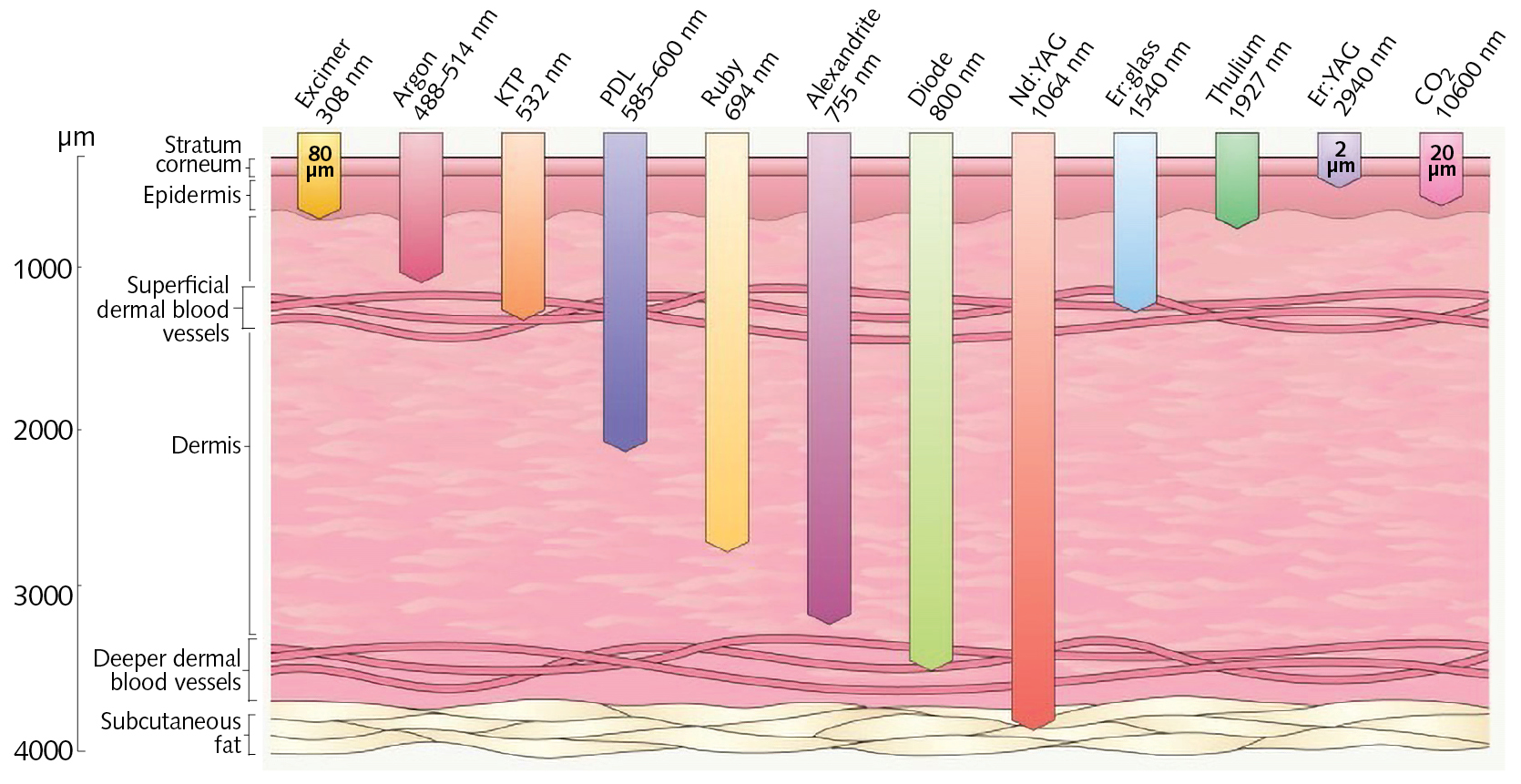 FIGURE 2. Lasers can penetrate deep into the dermis (1470 nm around 400 &mu;m, and 1550 nm up to 1600 &mu;m.