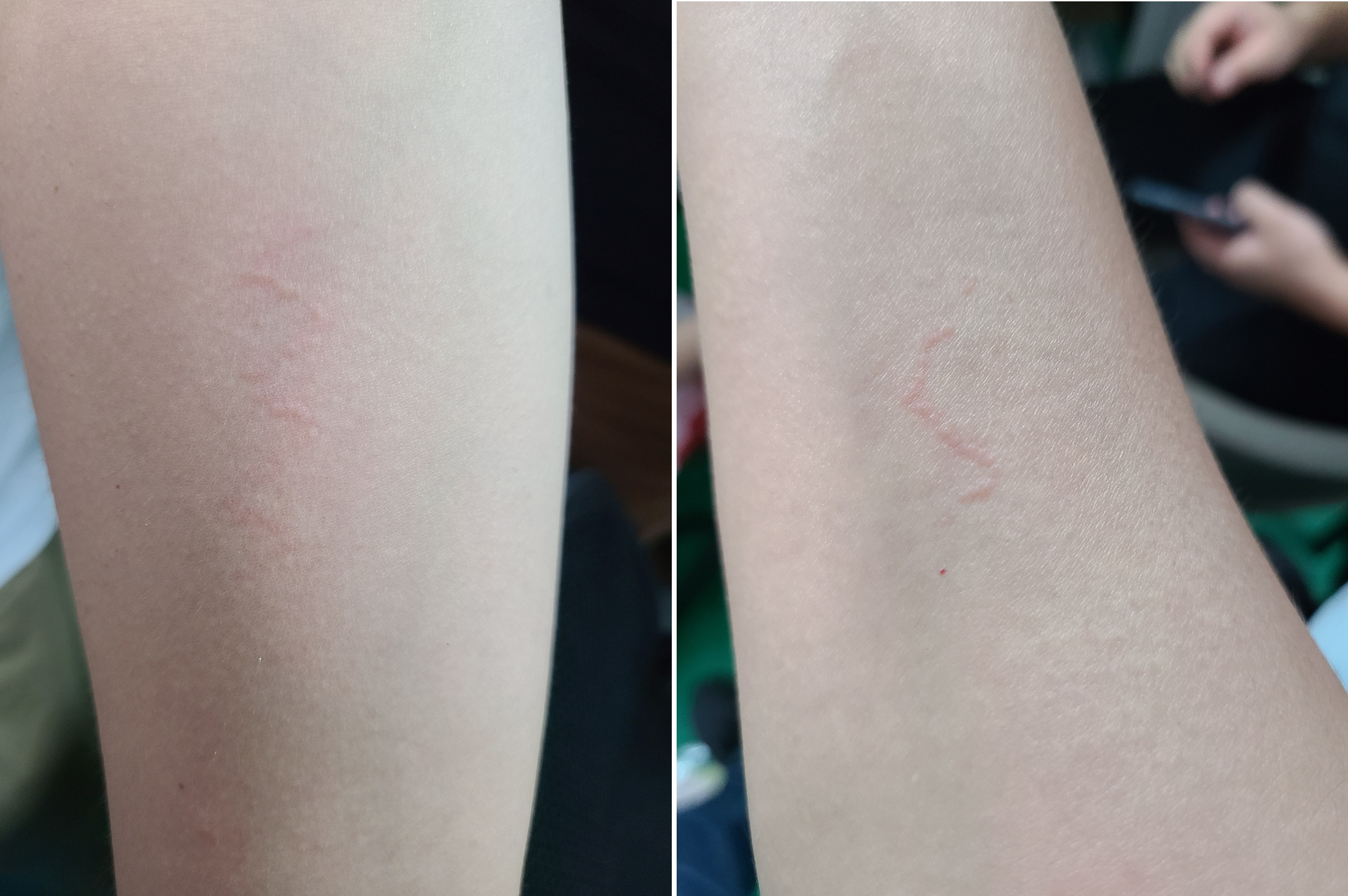 FIGURE 5. Less erythema can be seen after the treatment by the Focuslight demo system under 10 ms, at 10 mJ/spot.