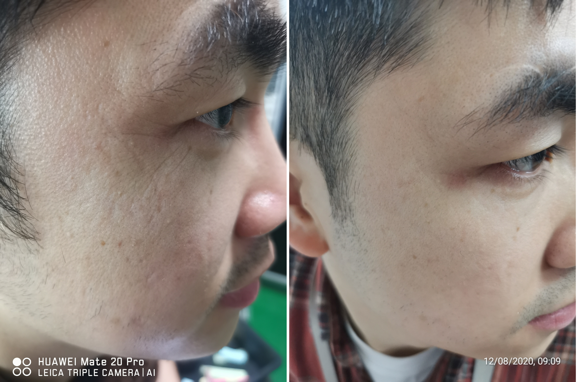 FIGURE 6. Treatment of periorbital wrinkles by the Focuslight demo system at 10 ms, at 10 mJ/spot. Treatment is done 3X per week; after 5 weeks, reduction in wrinkles can be seen.