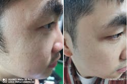 FIGURE 6. Treatment of periorbital wrinkles by the Focuslight demo system at 10 ms, at 10 mJ/spot. Treatment is done 3X per week; after 5 weeks, reduction in wrinkles can be seen. FIGURE 6. Treatment of periorbital wrinkles by the Focuslight demo system at 10 ms, at 10 mJ/spot. Treatment is done 3X per week; after 5 weeks, reduction in wrinkles can be seen.