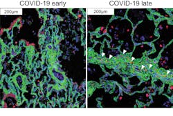 Immune cells (red) migrate near the cells that cause fibrosis (green) in late COVID-19. Immune cells (red) migrate near the cells that cause fibrosis (green) in late COVID-19.