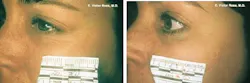 Candela claims its diode-laser skin-renewal approach differs from the skin-rejuvenation procedure commercialized by other companies. The Smoothbeam's 1450-nm wavelength heats the upper dermis (left), inducing mild thermal injury and prompting the body's natural healing response, resulting in collagen remodeling (right). Candela claims its diode-laser skin-renewal approach differs from the skin-rejuvenation procedure commercialized by other companies. The Smoothbeam's 1450-nm wavelength heats the upper dermis (left), inducing mild thermal injury and prompting the body's natural healing response, resulting in collagen remodeling (right).
