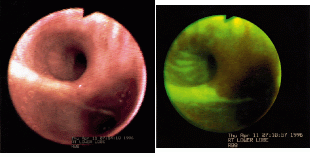 Conventional white-light examination of the lung typically shows tissue with slight reddening but no significant characteristics (left), while bronchoscopically positive lesions&mdash;those likely to be cancerous or precancerous&mdash;appear as focal or delineated reddish brown when illuminated by the Xillix LIFE system (right).