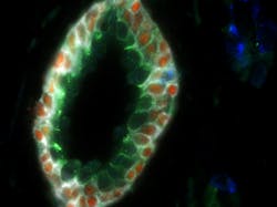 FIGURE 5. Fluorescent quantum dots (QDs) target the antibodies of certain cells and can be observed using a spectral imaging microscope. In this case, a single malignant prostate cancer cell (in blue) is identified among healthy proteins and cells (red, green, white) in the wall of a prostate gland. FIGURE 5. Fluorescent quantum dots (QDs) target the antibodies of certain cells and can be observed using a spectral imaging microscope. In this case, a single malignant prostate cancer cell (in blue) is identified among healthy proteins and cells (red, green, white) in the wall of a prostate gland.