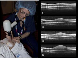 FIGURE 4. Ophthalmic photographer Cynthia VandenHoven uses Bioptigen's SDOCT (left) with a pediatric patient at the Hospital for Sick Children (Toronto, Ontario, Canada). The system produces cross-sectional images of pediatric retinoblastoma (right). FIGURE 4. Ophthalmic photographer Cynthia VandenHoven uses Bioptigen's SDOCT (left) with a pediatric patient at the Hospital for Sick Children (Toronto, Ontario, Canada). The system produces cross-sectional images of pediatric retinoblastoma (right).