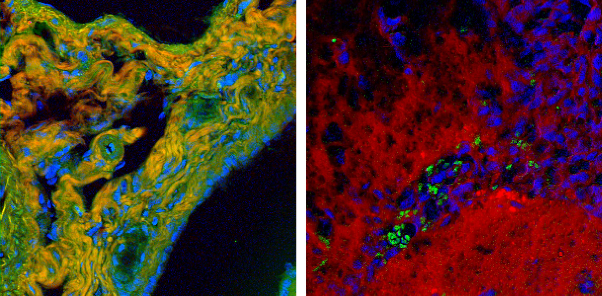 High-speed BCARS allows detailed mapping of specific components of tissue samples. A false-color BCARS image of mouse liver tissue (left) picks out cell nuclei in blue, collagen in orange, and proteins in green. An image of tumor and normal brain tissue from a mouse (right) has been colored to show cell nuclei in blue, lipids in red, and red blood cells in green. Images show an area about 200 &micro;m across.