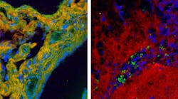 High-speed BCARS allows detailed mapping of specific components of tissue samples. A false-color BCARS image of mouse liver tissue (left) picks out cell nuclei in blue, collagen in orange, and proteins in green. An image of tumor and normal brain tissue from a mouse (right) has been colored to show cell nuclei in blue, lipids in red, and red blood cells in green. Images show an area about 200 &micro;m across.