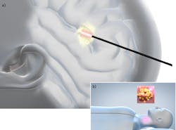 FIGURE 1. Laser-induced thermal therapy (LITT; a) and photodynamic therapy/ photoimmunotherapy (PDT/PIT; b) are used to treat cancer and other severe pathologies. FIGURE 1. Laser-induced thermal therapy (LITT; a) and photodynamic therapy/ photoimmunotherapy (PDT/PIT; b) are used to treat cancer and other severe pathologies.