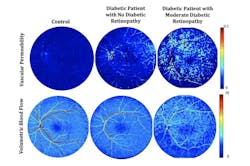 Retinal vascular permeability and blood flow maps produced by the dynamic tracer kinetic model from normal subject (left), diabetic patient with no diabetic retinopathy (middle), and diabetic patient with moderate diabetic retinopathy (right). Retinal vascular permeability and blood flow maps produced by the dynamic tracer kinetic model from normal subject (left), diabetic patient with no diabetic retinopathy (middle), and diabetic patient with moderate diabetic retinopathy (right).