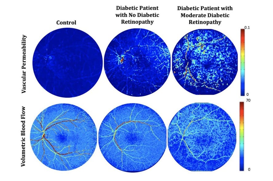 Retinal vascular permeability and blood flow maps produced by the dynamic tracer kinetic model from normal subject (left), diabetic patient with no diabetic retinopathy (middle), and diabetic patient with moderate diabetic retinopathy (right).