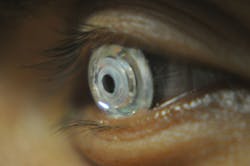 FIGURE 3. A contact lens that relies on aspheric-mirror zoom optics can switch between 1X and 2.8X magnification. While the lens is shown here being worn by a human, it was actually tested using a mechanical eye.