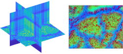 FIGURE 2. Hyperspectral datacube of a fatty liver biopsy under a 50x microscope: a 3D view of biopsy demonstrating the various slices in a datacube (left) and hyperspectral datacube analysis using endmembers algorithm (right) are shown. This datacube was obtained by members of the Berezin Lab at Washington University in St. Louis. FIGURE 2. Hyperspectral datacube of a fatty liver biopsy under a 50x microscope: a 3D view of biopsy demonstrating the various slices in a datacube (left) and hyperspectral datacube analysis using endmembers algorithm (right) are shown. This datacube was obtained by members of the Berezin Lab at Washington University in St. Louis.