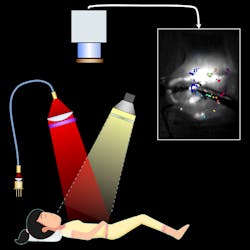 FIGURE 4. SWIFTI system schematic of real-time near-infrared (NIR) fluorescence image-guided surgery for tumor debulking in ovarian cancer patients. FIGURE 4. SWIFTI system schematic of real-time near-infrared (NIR) fluorescence image-guided surgery for tumor debulking in ovarian cancer patients.