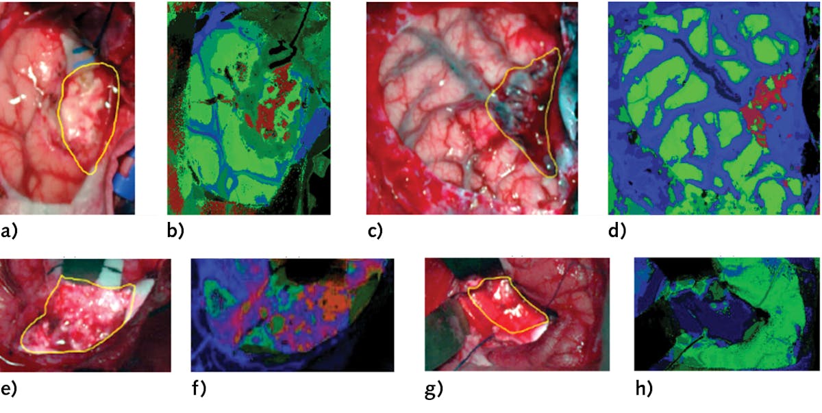 FIGURE 5. Tumor tissue identification results obtained from the validation database employing the HELICoiD demonstrator: synthetic RGB color image and spectral classification map of the primary glioblastoma hyperspectral image (a, b); synthetic RGB image and spectral classification map of the primary-grade I meningioma hyperspectral image (c, d); synthetic RGB image and spectral classification map of the primary grade II oligodendroglioma hyperspectral image (e, f); and synthetic RGB image and spectral classification map of the primary glioblastoma hyperspectral image (g, h).