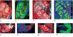 FIGURE 5. Tumor tissue identification results obtained from the validation database employing the HELICoiD demonstrator: synthetic RGB color image and spectral classification map of the primary glioblastoma hyperspectral image (a, b); synthetic RGB image and spectral classification map of the primary-grade I meningioma hyperspectral image (c, d); synthetic RGB image and spectral classification map of the primary grade II oligodendroglioma hyperspectral image (e, f); and synthetic RGB image and spectral classification map of the primary glioblastoma hyperspectral image (g, h). FIGURE 5. Tumor tissue identification results obtained from the validation database employing the HELICoiD demonstrator: synthetic RGB color image and spectral classification map of the primary glioblastoma hyperspectral image (a, b); synthetic RGB image and spectral classification map of the primary-grade I meningioma hyperspectral image (c, d); synthetic RGB image and spectral classification map of the primary grade II oligodendroglioma hyperspectral image (e, f); and synthetic RGB image and spectral classification map of the primary glioblastoma hyperspectral image (g, h).