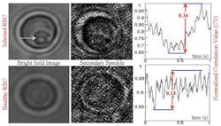 The difference between an infected red blood cell (top) and a healthy cell (bottom) is revealed by secondary speckle sensing microscopy (S3M), in part, by considering the dynamics of the correlation value (CV). CV indicates the similarity between two patterns. One-thousand CVs are calculated from pairs of consecutive speckles acquired in 1 s. As shown in the chart at right, the CV oscillation range for the infected cell (top, 0.36) is almost three times larger than that of the healthy red blood cell (bottom, 0.13). In the top left image of the infected cell, a parasitic life-cycle stage of malaria, called 'trophozoite,' can be seen (arrow). The difference between an infected red blood cell (top) and a healthy cell (bottom) is revealed by secondary speckle sensing microscopy (S3M), in part, by considering the dynamics of the correlation value (CV). CV indicates the similarity between two patterns. One-thousand CVs are calculated from pairs of consecutive speckles acquired in 1 s. As shown in the chart at right, the CV oscillation range for the infected cell (top, 0.36) is almost three times larger than that of the healthy red blood cell (bottom, 0.13). In the top left image of the infected cell, a parasitic life-cycle stage of malaria, called 'trophozoite,' can be seen (arrow).