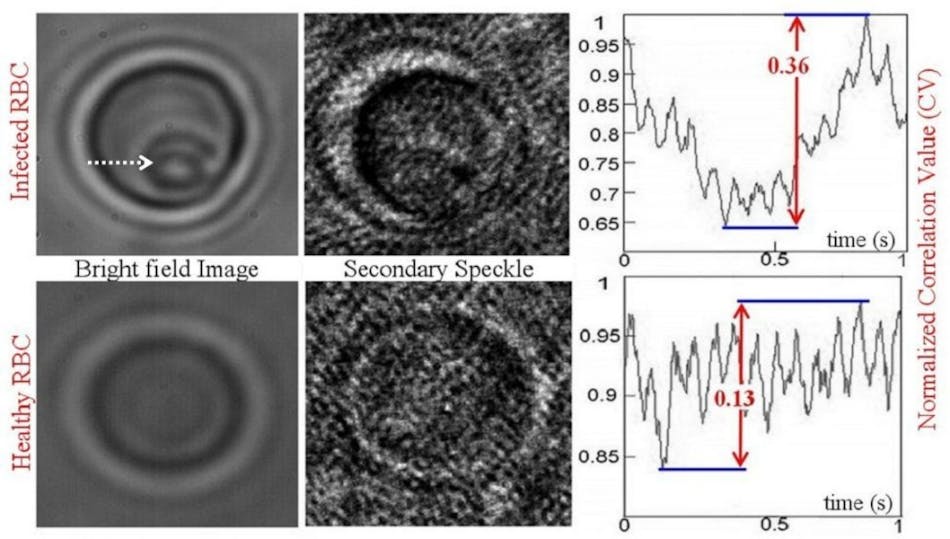 The difference between an infected red blood cell (top) and a healthy cell (bottom) is revealed by secondary speckle sensing microscopy (S3M), in part, by considering the dynamics of the correlation value (CV). CV indicates the similarity between two patterns. One-thousand CVs are calculated from pairs of consecutive speckles acquired in 1 s. As shown in the chart at right, the CV oscillation range for the infected cell (top, 0.36) is almost three times larger than that of the healthy red blood cell (bottom, 0.13). In the top left image of the infected cell, a parasitic life-cycle stage of malaria, called &apos;trophozoite,&apos; can be seen (arrow).