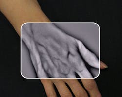 FIGURE 1. VueTek Scientific wanted to develop a portable vascular imaging product that would allow a medical practitioner to visualize and observe subcutaneous vasculature in real time. FIGURE 1. VueTek Scientific wanted to develop a portable vascular imaging product that would allow a medical practitioner to visualize and observe subcutaneous vasculature in real time.