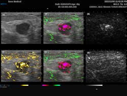 FIGURE 2. Six-panel display of the dual-mode PAI-ultrasound scan of a breast cancer tumor. Image (1) displays the grayscale ultrasound, (2) the grayscale ultrasound with the combined 757 nm (red) and 1064 nm (green) photoacoustic (PA) signals, (3) grayscale 757 nm PA signal, (4) grayscale ultrasound with the combined PA signal, (5) grayscale ultrasound with the combines 757 nm (red) and 1064 nm (green) PA signals filtered to reduce aliasing, and (6) grayscale 1064 nm PA signal.