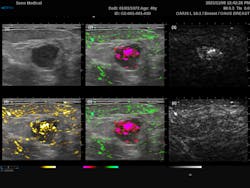 FIGURE 2. Six-panel display of the dual-mode PAI-ultrasound scan of a breast cancer tumor. Image (1) displays the grayscale ultrasound, (2) the grayscale ultrasound with the combined 757 nm (red) and 1064 nm (green) photoacoustic (PA) signals, (3) grayscale 757 nm PA signal, (4) grayscale ultrasound with the combined PA signal, (5) grayscale ultrasound with the combines 757 nm (red) and 1064 nm (green) PA signals filtered to reduce aliasing, and (6) grayscale 1064 nm PA signal. FIGURE 2. Six-panel display of the dual-mode PAI-ultrasound scan of a breast cancer tumor. Image (1) displays the grayscale ultrasound, (2) the grayscale ultrasound with the combined 757 nm (red) and 1064 nm (green) photoacoustic (PA) signals, (3) grayscale 757 nm PA signal, (4) grayscale ultrasound with the combined PA signal, (5) grayscale ultrasound with the combines 757 nm (red) and 1064 nm (green) PA signals filtered to reduce aliasing, and (6) grayscale 1064 nm PA signal.
