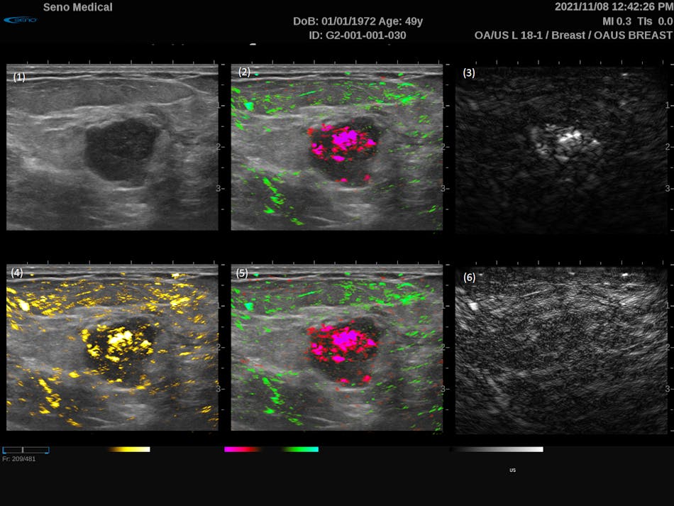 FIGURE 2. Six-panel display of the dual-mode PAI-ultrasound scan of a breast cancer tumor. Image (1) displays the grayscale ultrasound, (2) the grayscale ultrasound with the combined 757 nm (red) and 1064 nm (green) photoacoustic (PA) signals, (3) grayscale 757 nm PA signal, (4) grayscale ultrasound with the combined PA signal, (5) grayscale ultrasound with the combines 757 nm (red) and 1064 nm (green) PA signals filtered to reduce aliasing, and (6) grayscale 1064 nm PA signal.