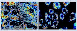 Web-like arrangement of mitochondria in normal cells (left) contrasts sharply with the clustered mitochondria surrounding the cell nucleus in cancer cells (right). Web-like arrangement of mitochondria in normal cells (left) contrasts sharply with the clustered mitochondria surrounding the cell nucleus in cancer cells (right).