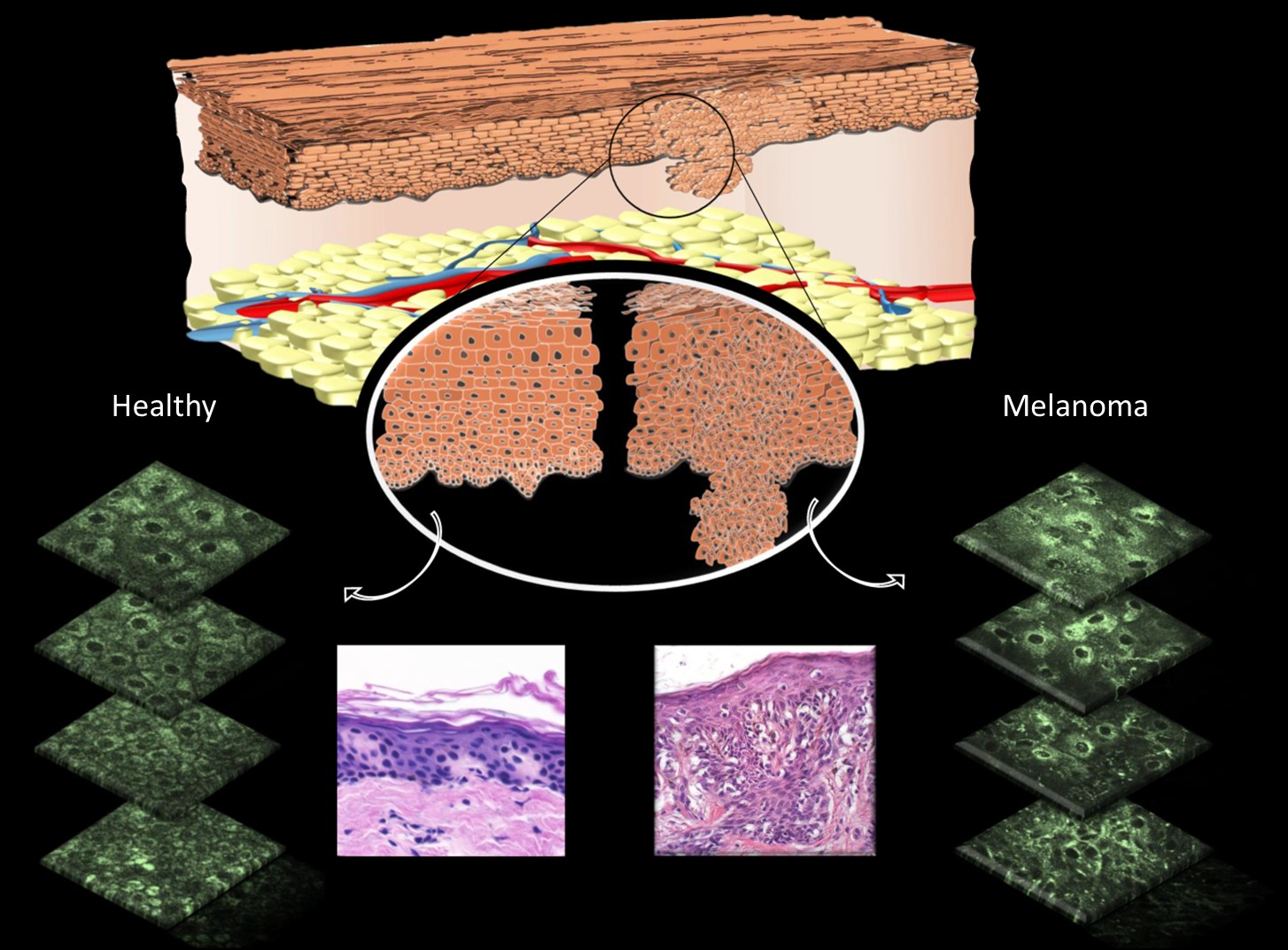 Diagram showing differences that can be observed in cell morphology in normal skin cells versus melanomas. Pink images show differences following biopsy and staining by a pathologist. Green slices show differences in fluorescence pattern of mitochondria using multiphoton microscopy.
