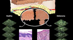 Diagram showing differences that can be observed in cell morphology in normal skin cells versus melanomas. Pink images show differences following biopsy and staining by a pathologist. Green slices show differences in fluorescence pattern of mitochondria using multiphoton microscopy.