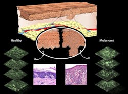 Diagram showing differences that can be observed in cell morphology in normal skin cells versus melanomas. Pink images show differences following biopsy and staining by a pathologist. Green slices show differences in fluorescence pattern of mitochondria using multiphoton microscopy. Diagram showing differences that can be observed in cell morphology in normal skin cells versus melanomas. Pink images show differences following biopsy and staining by a pathologist. Green slices show differences in fluorescence pattern of mitochondria using multiphoton microscopy.