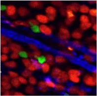 T-cells (green) hunt down tumor cells (red). T-cells (green) hunt down tumor cells (red).