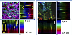 A new chromatic confocal microscope images stomach tissue to a depth of about 200 µm with no mechanical depth scanning. The images of excised normal (left) and cancerous (right) human stomach tissue show clear differences, motivating continued development to make the probe suitable for endomicroscopy. A new chromatic confocal microscope images stomach tissue to a depth of about 200 µm with no mechanical depth scanning. The images of excised normal (left) and cancerous (right) human stomach tissue show clear differences, motivating continued development to make the probe suitable for endomicroscopy.