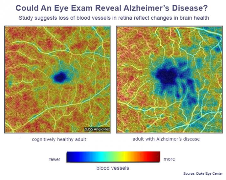 New research from Duke Eye Center suggests loss of blood vessels in the retina could signal Alzheimer's disease. On the left, the retina of a healthy person shows a dense web of blood vessels, the highest-density areas highlighted in red and orange. On the right, the retina of a person with Alzheimer's disease shows areas in blue and teal where blood vessels are least dense. The images were captured using optical coherence tomography angiography (OCTA).