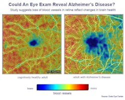 New research from Duke Eye Center suggests loss of blood vessels in the retina could signal Alzheimer's disease. On the left, the retina of a healthy person shows a dense web of blood vessels, the highest-density areas highlighted in red and orange. On the right, the retina of a person with Alzheimer's disease shows areas in blue and teal where blood vessels are least dense. The images were captured using optical coherence tomography angiography (OCTA). New research from Duke Eye Center suggests loss of blood vessels in the retina could signal Alzheimer's disease. On the left, the retina of a healthy person shows a dense web of blood vessels, the highest-density areas highlighted in red and orange. On the right, the retina of a person with Alzheimer's disease shows areas in blue and teal where blood vessels are least dense. The images were captured using optical coherence tomography angiography (OCTA).