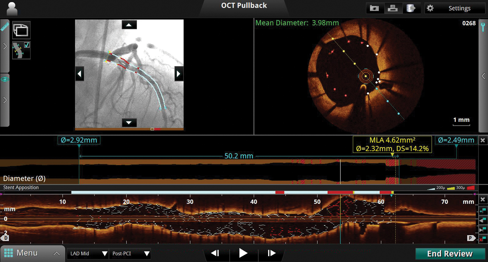 St. Jude Medical Optical Coherence Tomography (OCT) Software features automated measurements, co-registered angiography views, and new stent deployment features.