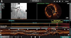 St. Jude Medical Optical Coherence Tomography (OCT) Software features automated measurements, co-registered angiography views, and new stent deployment features. St. Jude Medical Optical Coherence Tomography (OCT) Software features automated measurements, co-registered angiography views, and new stent deployment features.