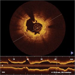 FIGURE 3. OCT highlights in-stent restenosis in a patient who has just undergone balloon dilatation. FIGURE 3. OCT highlights in-stent restenosis in a patient who has just undergone balloon dilatation.