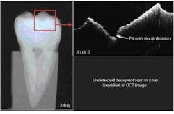 FIGURE 4. Decay not detected by an x-ray (left) is evident in the OCT image. FIGURE 4. Decay not detected by an x-ray (left) is evident in the OCT image.