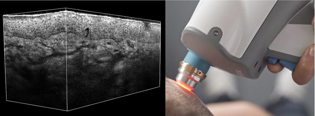 OCT, Raman combo enhances dermatology diagnoses | Laser Focus World