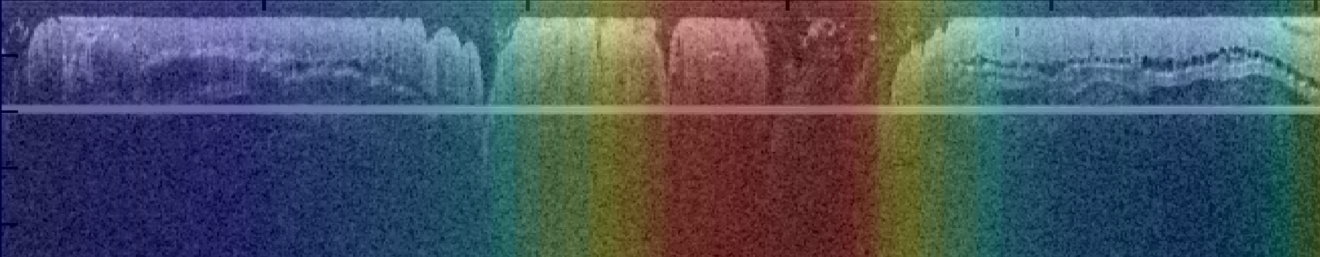 An OCT image, combined with spectroscopic autofluorescence information, depicts a colon. The peak emission intensity has been mapped to a false color scale, where blue = 430 nm and red = 490 nm. The autofluorescence emission is red-shifted in the region of the tumor, in the center of the image.