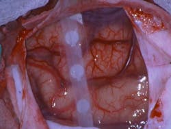 A human brain exposed during neurosurgery. Three images are merged, corresponding to red (628 nm), green (530 nm), and blue (460 nm) reflectance. Changes in reflectance over time can be analyzed to show dilations and oxygenation changes resulting from functional activation. A 3-position electrode strip providing electrophysiological recordings can be seen across the center. Field of view: ~6 × 4 cm. A human brain exposed during neurosurgery. Three images are merged, corresponding to red (628 nm), green (530 nm), and blue (460 nm) reflectance. Changes in reflectance over time can be analyzed to show dilations and oxygenation changes resulting from functional activation. A 3-position electrode strip providing electrophysiological recordings can be seen across the center. Field of view: ~6 × 4 cm.