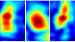 FIGURE 2. Researchers at Stevens Institute of Technology are developing a handheld device based on millimeter-wave imaging technology that can scan skin and detect different types of cancer including carcinoma (left), squamous cell carcinoma (middle), and actinic keratosis (right). FIGURE 2. Researchers at Stevens Institute of Technology are developing a handheld device based on millimeter-wave imaging technology that can scan skin and detect different types of cancer including carcinoma (left), squamous cell carcinoma (middle), and actinic keratosis (right).