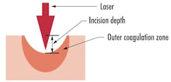 FIGURE 2. Depiction of the coagulation zone formed under 2 µm laser radiation, which minimizes bleeding. FIGURE 2. Depiction of the coagulation zone formed under 2 µm laser radiation, which minimizes bleeding.