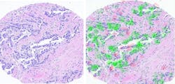 FIGURE 1. The original biopsy image (left) and the areas where information was extracted in red and green (right) using the technology developed at the Technion-Israel Institute of Technology. FIGURE 1. The original biopsy image (left) and the areas where information was extracted in red and green (right) using the technology developed at the Technion-Israel Institute of Technology.