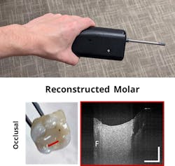 FIGURE 5. Dental handheld OCT probe, developed by Lumedica; this sample image shows a composite filling (F). FIGURE 5. Dental handheld OCT probe, developed by Lumedica; this sample image shows a composite filling (F).