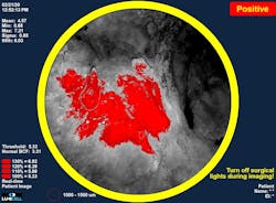 FIGURE 2. Real-time images from inside the breast cavity, based on a patient-calibrated cancer detection software, guide the surgeon in the removal of residual cancerous tissue. FIGURE 2. Real-time images from inside the breast cavity, based on a patient-calibrated cancer detection software, guide the surgeon in the removal of residual cancerous tissue.